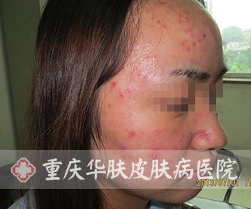 额头和面部青春痘的症状表现