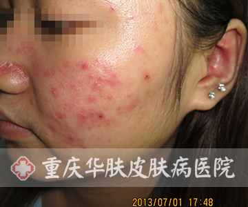脸面部位青春痘的症状特点