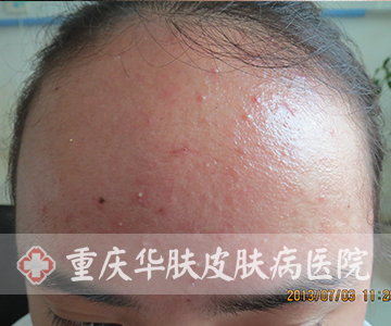 治疗两天后额头痘痘的症状表现