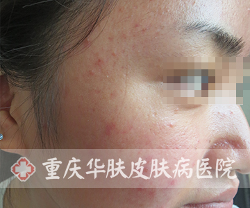 经过两天治疗后右脸的痘痘症状表现
