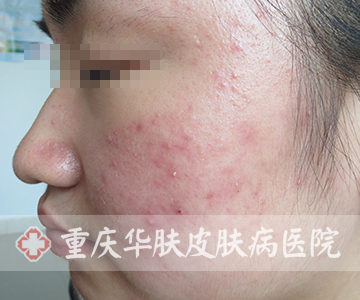 治疗两天后左脸的痘痘症状表现