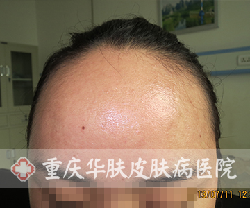 治疗后额头部位恢复正常