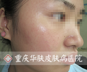 治疗后右脸部位恢复正常