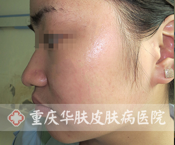 治疗后左脸部位恢复正常