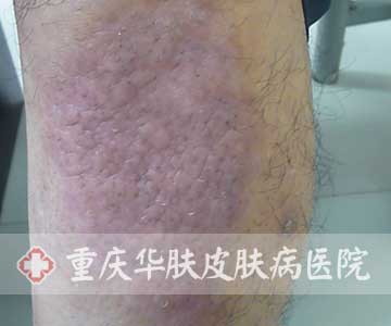 治疗10天后患者腿部症状