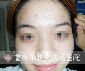 治疗前面部及额头部位痘痘的症状表现