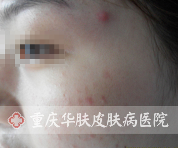 治疗前左脸痘痘的症状表现