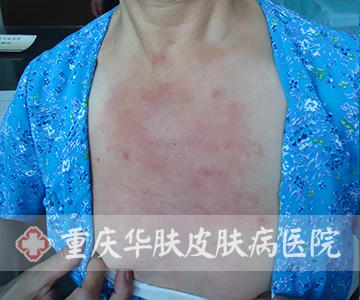 皮炎患者治疗前