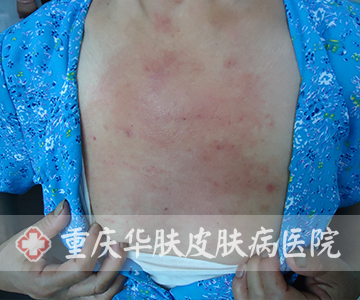 接触性皮炎患者治疗前