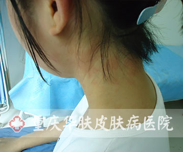 治疗前后颈荨麻疹症状表现