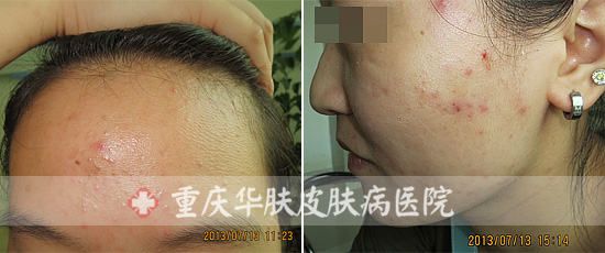面部皮炎半个月康复（大图治疗全过程）