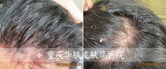 头部脂溢性皮炎 8天痊愈（大图治疗全过程）