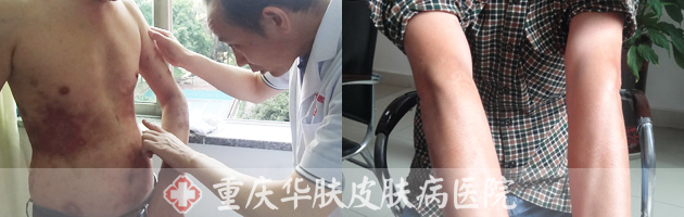 医生给患者诊断牛皮癣情况