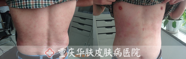 牛皮癣患者恢复情况对比图