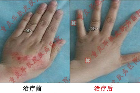 手部荨麻疹治疗前后对比