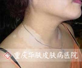来院时颈部白癜风的症状