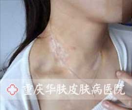 白癜风治疗中
