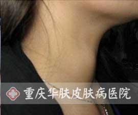  白癜风患者康复后