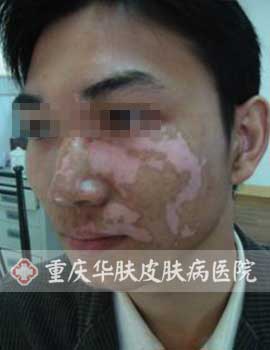 陈先生来院治疗中图片