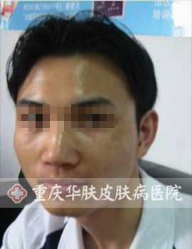 陈先生康复后图片