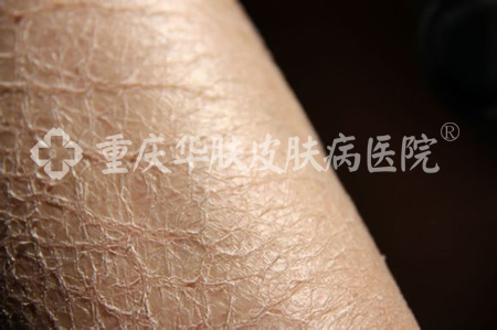 华肤皮肤病专家解答鱼鳞病