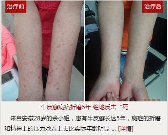 看牛皮癣去重庆哪家医院比较好