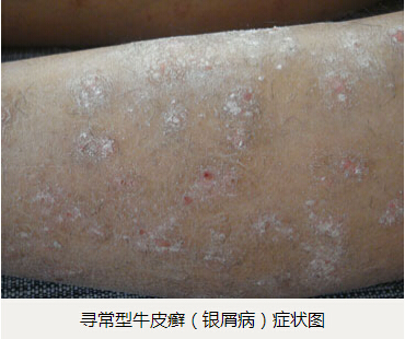 重庆哪个医院治疗牛皮癣最有效