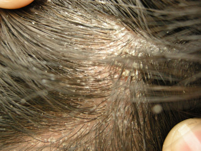 脂溢性皮炎或造成脱发吗