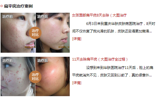 重庆皮肤科医院[扁平疣]