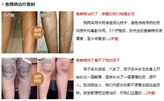 重庆哪里的皮肤科医院看鱼鳞病好