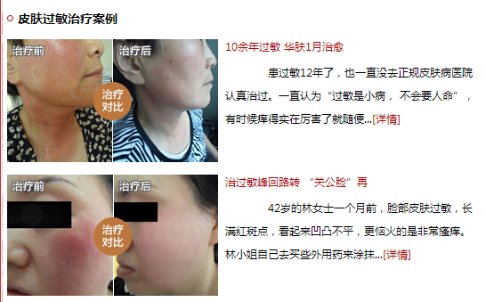 重庆皮肤病医院[过敏案例]