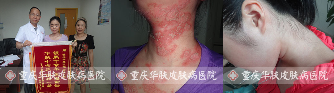 重庆皮肤病医院_皮肤科_预约挂号