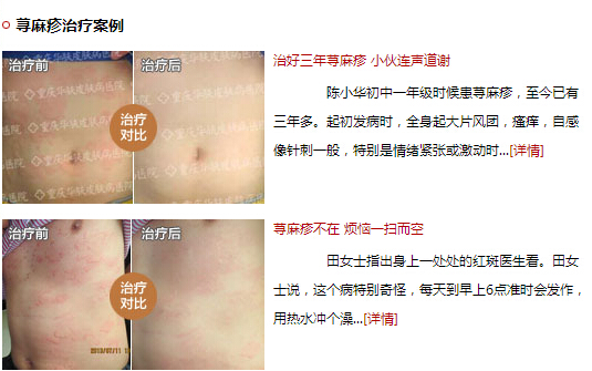 重庆华肤医院治疗荨麻疹怎么样