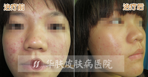 皮肤病都会对皮肤、心里有些影响