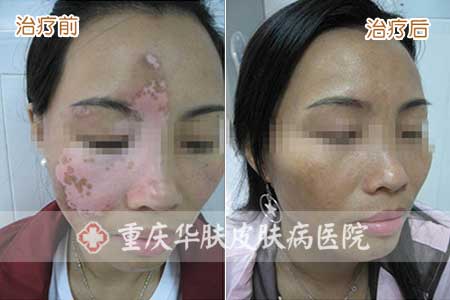 重庆皮肤病医院_皮肤科_预约挂号