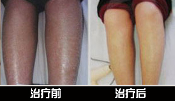 重庆皮肤病医院_皮肤科_预约挂号