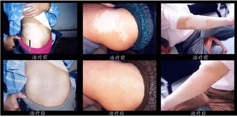 治鱼鳞病最好的医院是哪个[皮肤病]