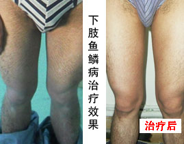 重庆皮肤病医院治疗鱼鳞病的案例，鱼鳞病的症状，鱼鳞病的病因，治疗鱼鳞病的效果