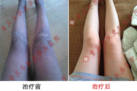 重庆皮肤病医院治疗鱼鳞病的案例，鱼鳞病的症状，鱼鳞病的病因，治疗鱼鳞病的效果