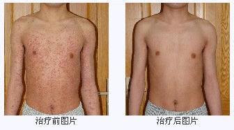 重庆皮肤病医院