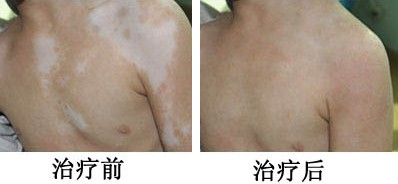 白癜风与麻风白斑斑的区别