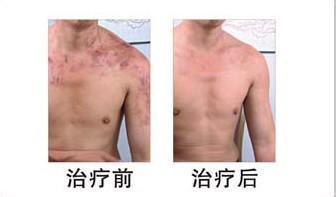 重庆皮肤病医院治疗白癜风案例图，重庆皮肤科医院治疗白癜风怎么样_好不好_多少钱_白癜风症状图