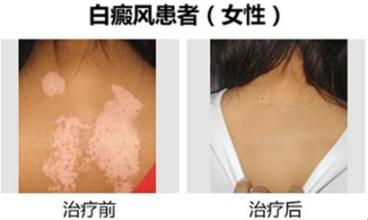 重庆皮肤病医院治疗白癜风案例图，重庆皮肤科医院治疗白癜风怎么样_好不好_多少钱_白癜风症状图