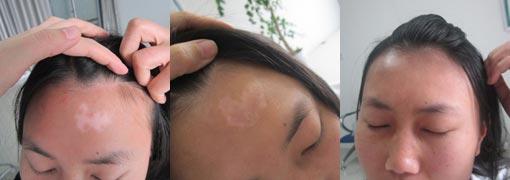 重庆皮肤病医院治疗白癜风案例图，重庆皮肤科医院治疗白癜风怎么样_好不好_多少钱_白癜风症状图
