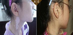 重庆皮肤病医院治疗白癜风案例图，重庆皮肤科医院治疗白癜风怎么样_好不好_多少钱_白癜风症状图