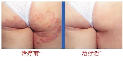 牛皮癣怎么治疗比较好