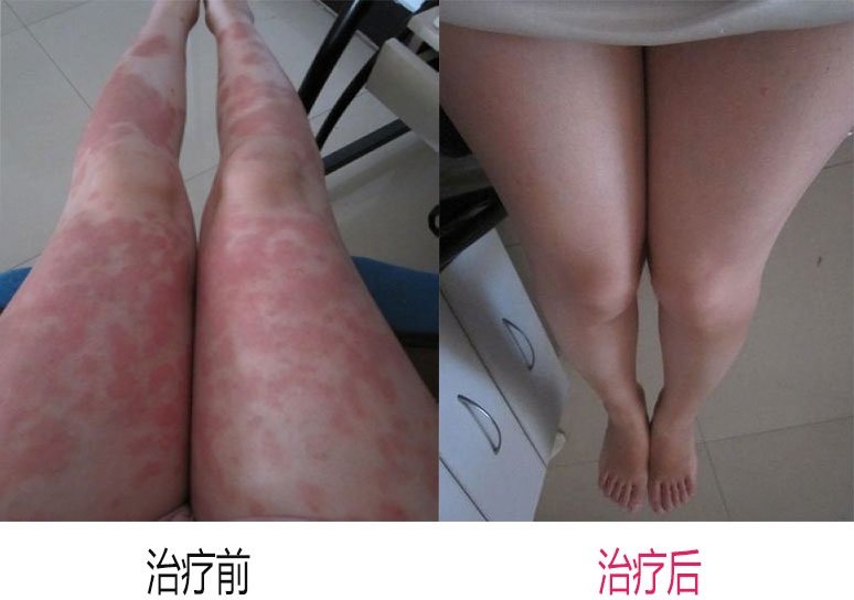 牛皮癣哪个医院治疗最好