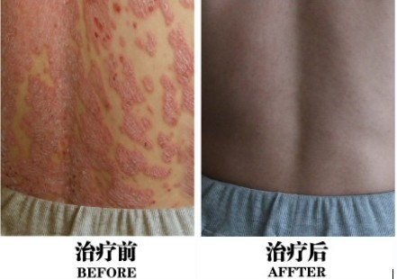重庆华肤医院[治牛皮癣]好吗