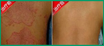 患皮肤病应该怎样治疗