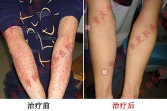 重庆皮肤病医院治疗牛皮癣_重庆皮肤科医院治疗牛皮癣